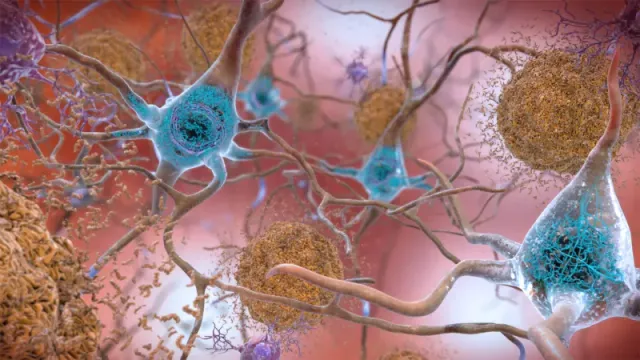 Descoberta Promissora para o Alzheimer: Um Novo Medicamento