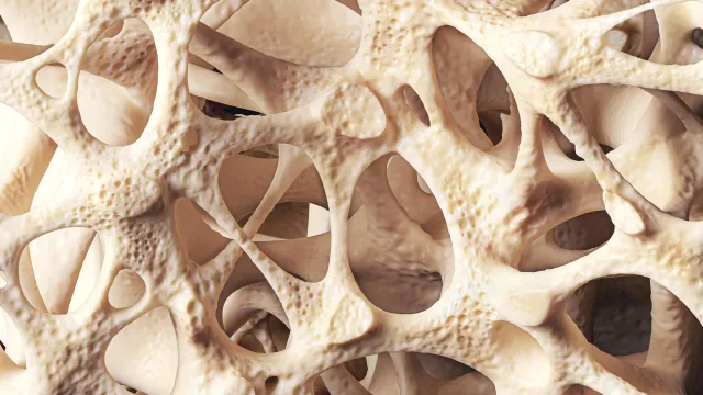 A Osteopenia: Uma Condição Silenciosa que Fraqueja os Osso